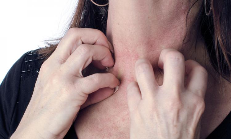 Dermatite de calor: como identificar e tratar brotoeja